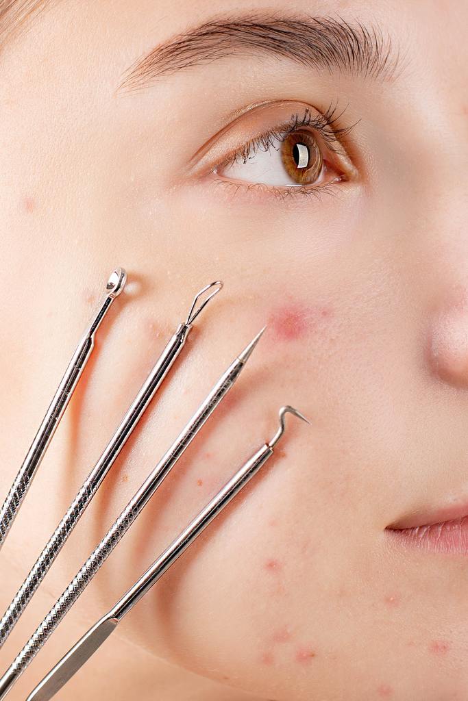 Blackhead Extractor Tools Kit